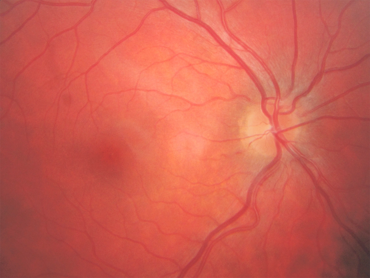 Retinografia