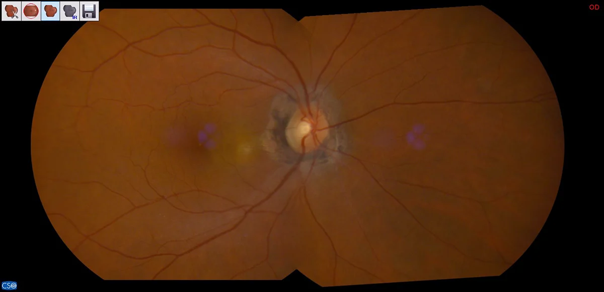 Retinografia